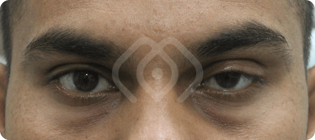 Patient suffering from droopy eyelid